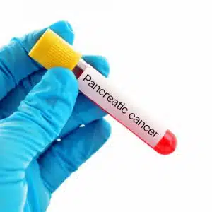 CA19 9 test, Pancreatic blood test home kit image