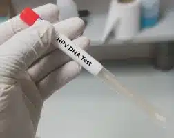 HPV, test CA125